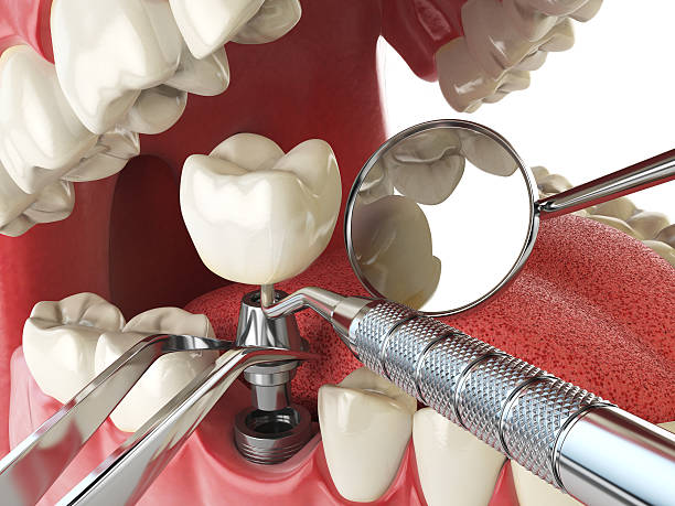 Best Emergency Dentist for Knocked-Out Tooth in Oxford, OH